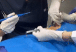 نمونه جراحی بوکال فت دکتر رضا قندهاری (کلینیک زیبایی ماهان)