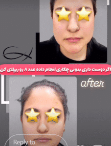 نمونه جراحی بوکال فت دکتر رضا قندهاری (کلینیک زیبایی ماهان)