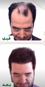 نمونه کاشت مو کلینیک زیبایی نوین ایرانا