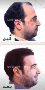 نمونه کاشت مو کلینیک زیبایی نوین ایرانا