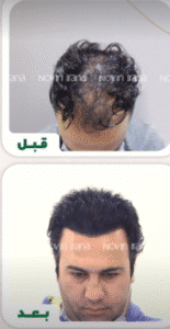 نمونه کاشت مو کلینیک زیبایی نوین ایرانا
