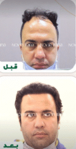 نمونه کاشت مو کلینیک زیبایی نوین ایرانا