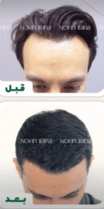 نمونه کاشت مو کلینیک زیبایی نوین ایرانا
