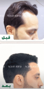 نمونه کاشت مو کلینیک زیبایی نوین ایرانا