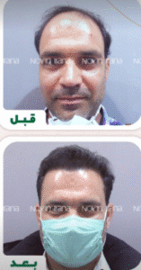 نمونه کاشت مو کلینیک زیبایی نوین ایرانا