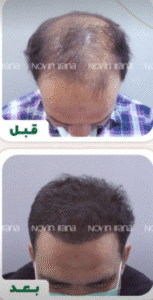 نمونه کاشت مو کلینیک زیبایی نوین ایرانا