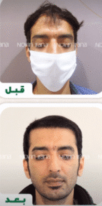 نمونه کاشت مو کلینیک زیبایی نوین ایرانا