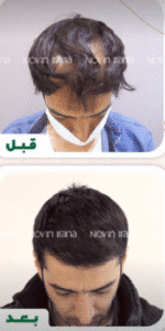 نمونه کاشت مو کلینیک زیبایی نوین ایرانا