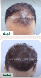نمونه کاشت مو کلینیک زیبایی نوین ایرانا