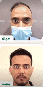 نمونه کاشت مو کلینیک زیبایی نوین ایرانا