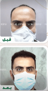 نمونه کاشت مو کلینیک زیبایی نوین ایرانا