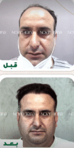 نمونه کاشت مو کلینیک زیبایی نوین ایرانا
