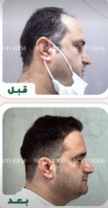 نمونه کاشت مو کلینیک زیبایی نوین ایرانا