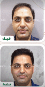 نمونه کاشت مو کلینیک زیبایی نوین ایرانا