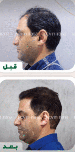 نمونه کاشت مو کلینیک زیبایی نوین ایرانا