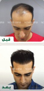 نمونه کاشت مو کلینیک زیبایی نوین ایرانا