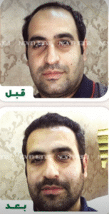 نمونه کاشت مو کلینیک زیبایی نوین ایرانا