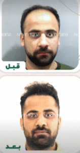 نمونه کاشت مو کلینیک زیبایی نوین ایرانا