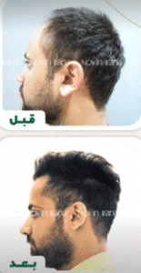 نمونه کاشت مو کلینیک زیبایی نوین ایرانا