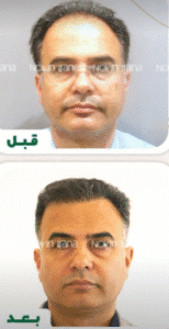 نمونه کاشت مو کلینیک زیبایی نوین ایرانا