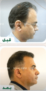 نمونه کاشت مو کلینیک زیبایی نوین ایرانا