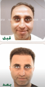 نمونه کاشت مو کلینیک زیبایی نوین ایرانا
