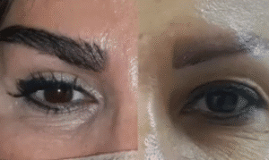 نمونه کاشت ابرو کلینیک زیبایی مانا