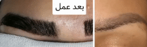 نمونه کاشت ابرو کلینیک زیبایی مانا