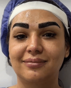 نمونه کاشت ابرو کلینیک زیبایی مانا