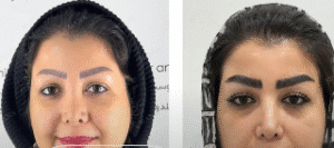 نمونه کاشت ابرو کلینیک زیبایی مانا