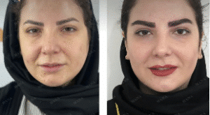 نمونه کاشت ابرو کلینیک زیبایی مانا
