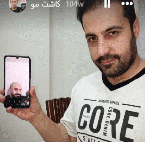 نمونه کاشت مو کلینیک زیبایی مانا