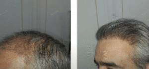 نمونه کاشت مو کلینیک زیبایی مانا