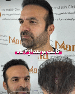 نمونه کاشت مو کلینیک زیبایی مانا