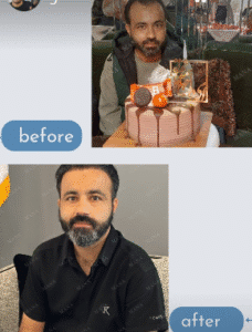 نمونه کاشت مو کلینیک زیبایی مانا