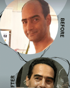 نمونه کاشت مو کلینیک زیبایی مانا