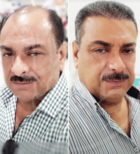 نمونه کاشت مو کلینیک زیبایی ماهان