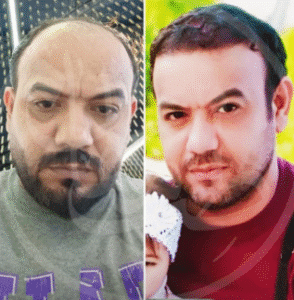 نمونه کاشت مو کلینیک زیبایی ماهان