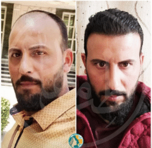 نمونه کاشت مو کلینیک زیبایی ماهان