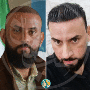 نمونه کاشت مو کلینیک زیبایی ماهان