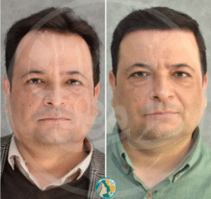 نمونه کاشت مو کلینیک زیبایی ماهان