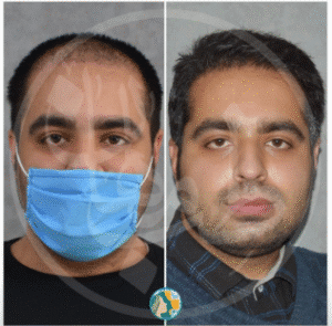 نمونه کاشت مو کلینیک زیبایی ماهان