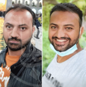 نمونه کاشت مو کلینیک زیبایی ماهان