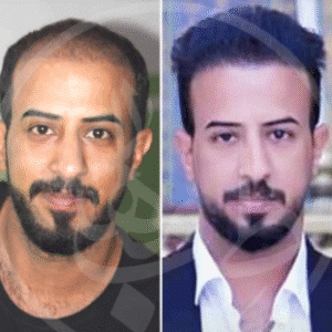 نمونه کاشت مو کلینیک زیبایی ماهان