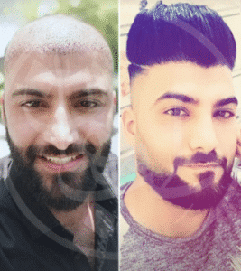 نمونه کاشت مو کلینیک زیبایی ماهان