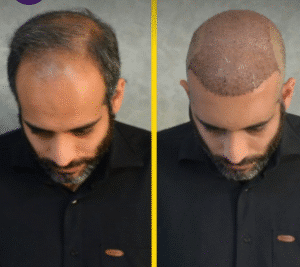 نمونه کاشت مو کلینیک زیبایی ماهان