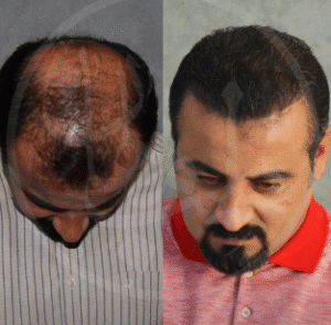 نمونه کاشت مو کلینیک زیبایی ماهان