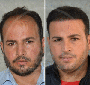 نمونه کاشت مو کلینیک زیبایی ماهان