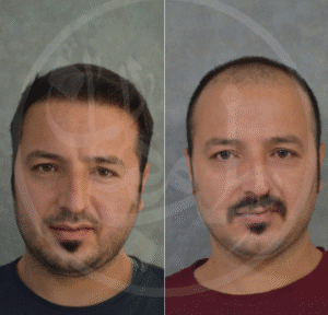 نمونه کاشت مو کلینیک زیبایی ماهان