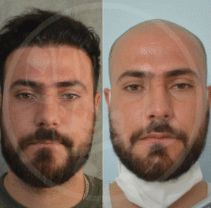 نمونه کاشت مو کلینیک زیبایی ماهان